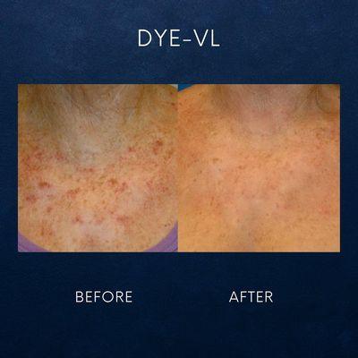 Dye-VL Chest!