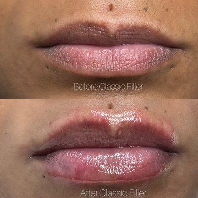 1.5 Lip Filler. Check out our Instagram @cloud9beautylab Text 562-375-8234 to book