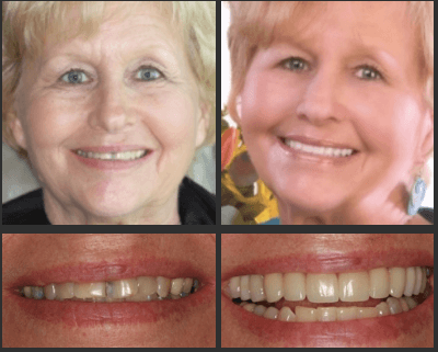 Feel the joy of a smile makeover after visiting the office of Esler Dental Group in Amarillo, Texas.