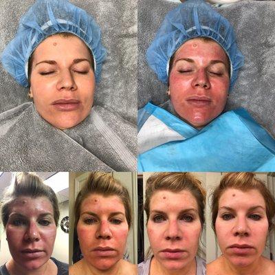 Microneedling Progression