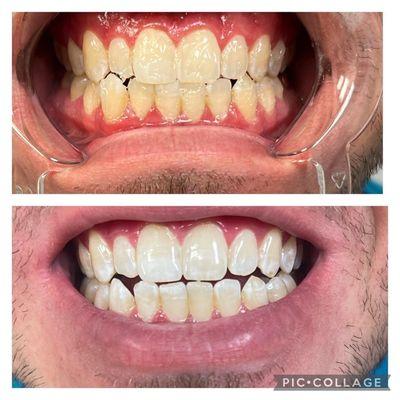 Teeth whitening that will have immediate results.