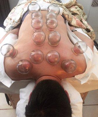 Cupping therapy