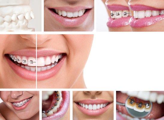 Affordable Dental Braces Arlington, Orthodontics in Arlington TX