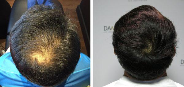 DAMO Hair Loss Clinic