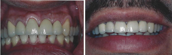 Dr. Janak Patel completed a thorough examination of Hector's teeth, took molds of his teeth and performed a smile analysis be...