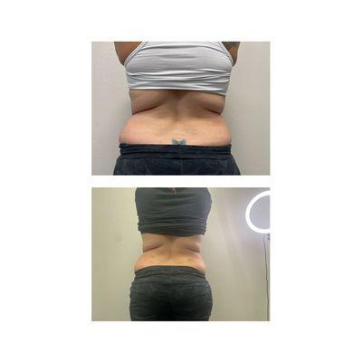 2 treatments of lipo cavitation