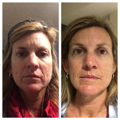 8 Microdermabrasion Treatments 7 days apart, plus Le Mieux Anti-Aging products