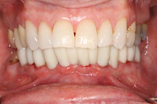 Beautiful full lower set of teeth supported by implants.