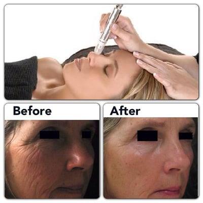 Best anti-aging treatment! Three technologies in one...simply amazing!