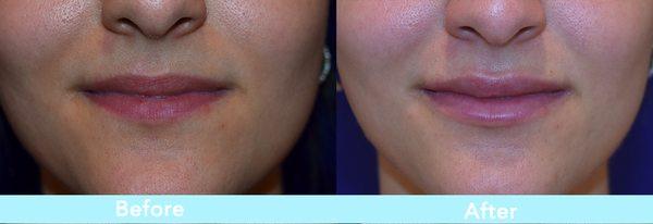 Natural Lip enhancement with Dr Zadeh