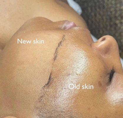 Dermaplane facial