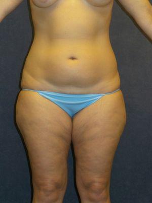 Female, 41 yr old BEFORE LIPOSUCTION