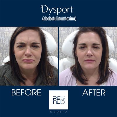 #Dysport at Re:nu 180 Medspa