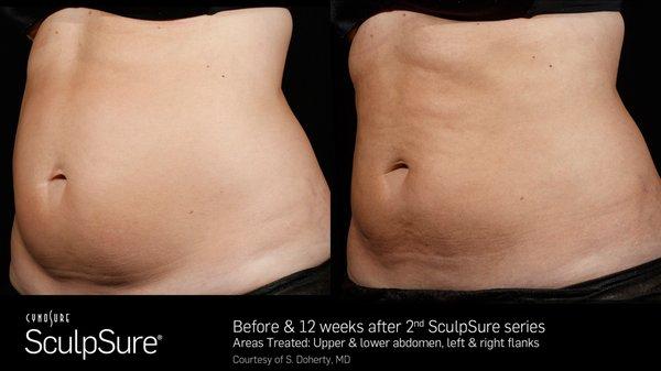 Before & After SculpSure