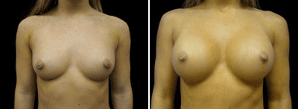 Breast Augmentation Before & After