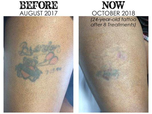 Tattoo removal results from Invisible Ink Tattoo Removers in Atlanta, Ga! Great job so far Ashley!