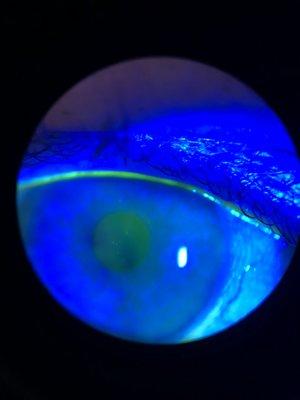 Corneal disease and dry eye are areas of expertise for Dr. Vale and his staff at InterMountain Eye.