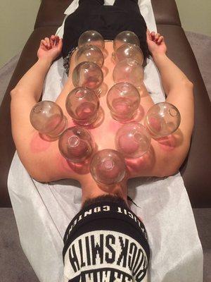 Some cupping. I tend to use bigger cups than this to provide a deeper effect.