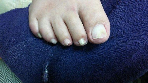 Toenail repair before polish.