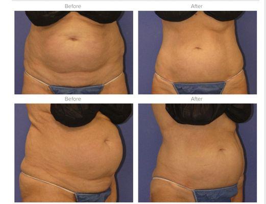 Coolsculpting Experts