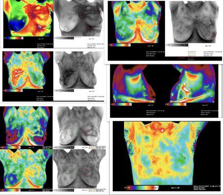 Can breast images in color palate and grey palate. Notice the dark blood flow patterns in grey images.