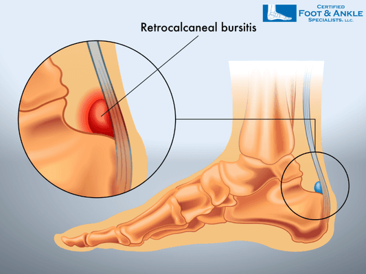 Bursitis Heel Pain Treatment in Fort Myers, Florida