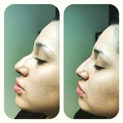 10 minute nose job!