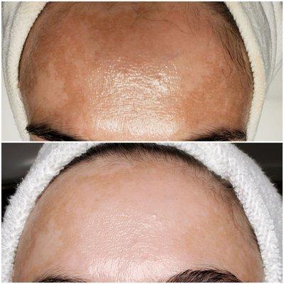 Before and After  Client has hormonal Pigmentation ( aka Melasma) PCA Chemical Peels and a consistent, personalized homecare routine