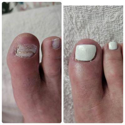 We all experience discomfort when we lose a toenail. However, observe this remarkable transformation achieved by our skilled nail technician