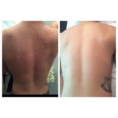 Deep Sea Herbal back peels- lighten acne scars and backcne