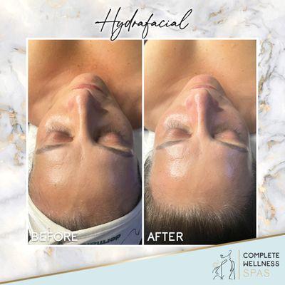 Best Facial around-hydrafacial, glow now