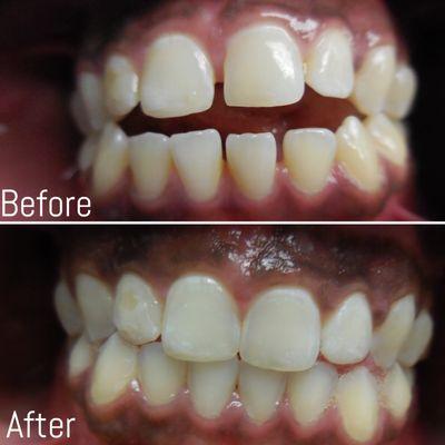 Invisalign - open bite - before / after