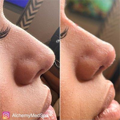 Non surgical nose augmentation