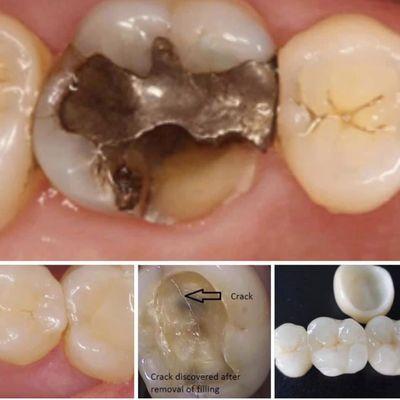 Cracked tooth can be restored with Beautiful Crown