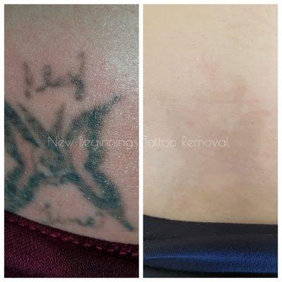 Before and after laser tattoo removal. The remainder of ink will clear over the next 12 weeks.