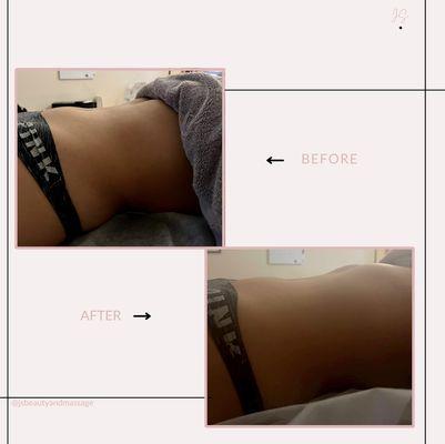 Before and after (lymphatic drainage)