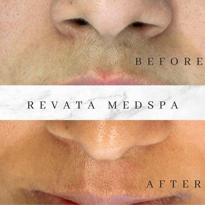 Revata Medspa Laser Facial with Microdermabrasion and skin Treatment