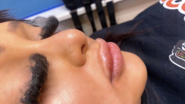 Lips filler