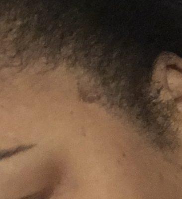 Stylist burnt the side of my hair while pressing my edges. ( see scab in the pic)