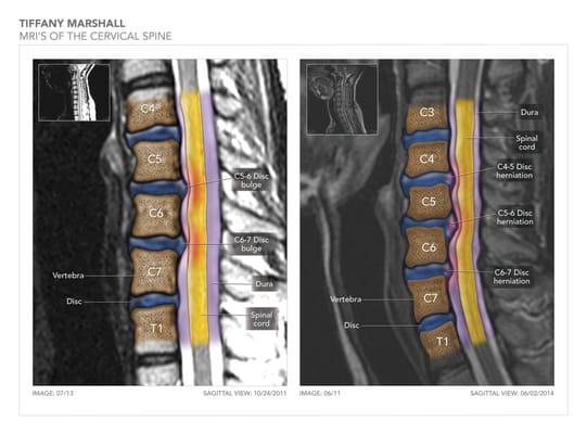 This is an exhibit used in a herniated cervical disc case. 