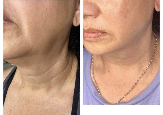 Fibroblast and Jett plasma treatments. 1 year between before and after.