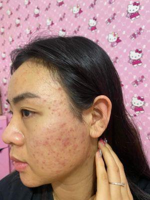 Befor after with Acne facial KHA OANH SKIN CARE