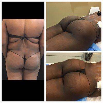 Post-Op Fat transfer to BB.