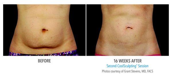 Check out these amazing Coolsculpting results!