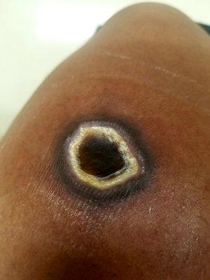 This is the burn once it turned nacrotic after over a month of treatment with medihoney.