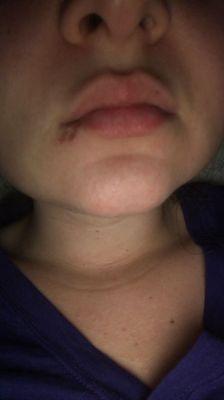 Left with a scar under my lip from extraction.