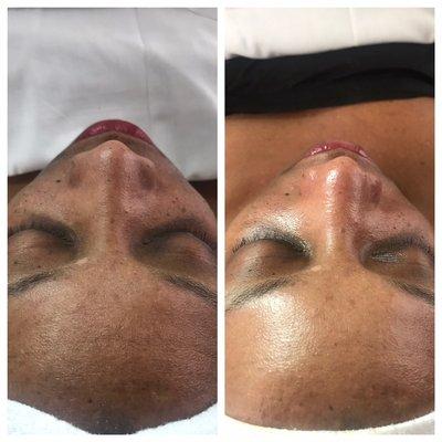 Resurfacing Treatment