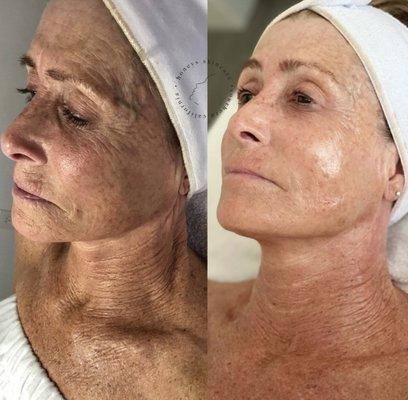 Anti Aging results by Esthetician Sara