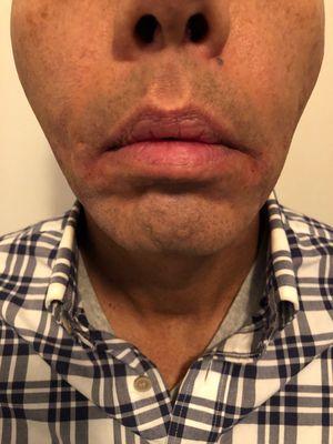 Immediately following Belotero Balance treatment on corners of mouth