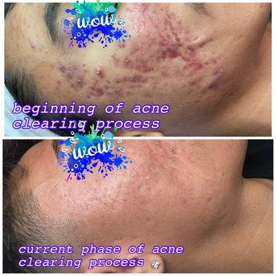 Male Client with severe acne has had amazing results!